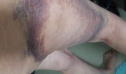 photo de la cuisse 2 semaines après la première photo. L'hématome traumatique est toujours présent avec le violet seulement au bord de l'hématome traumatique.